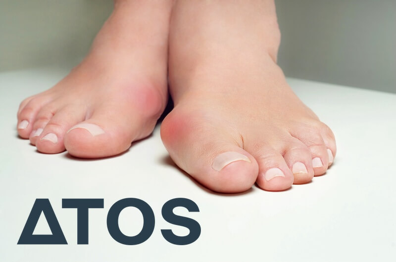 Morawe Hallux Valgus