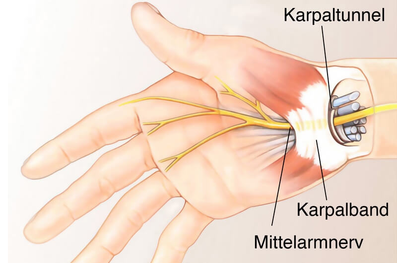 Karpaltunnelsyndrom ATOS Kliniken