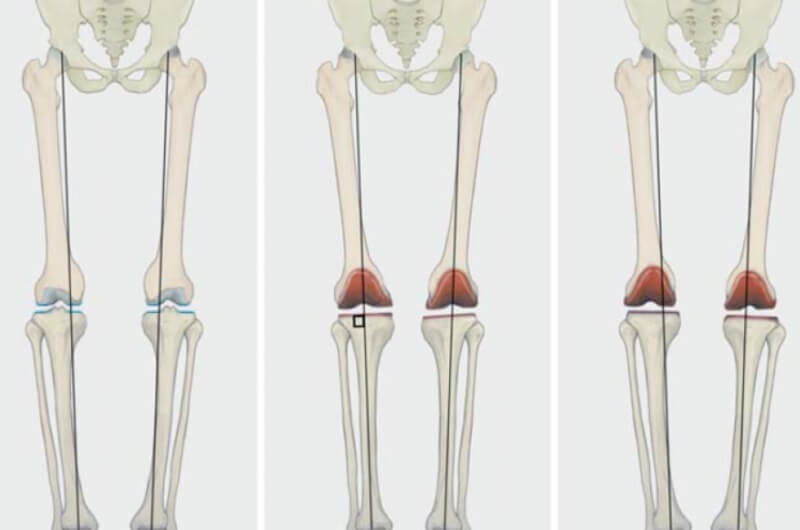 Knieendoprothetik ATOS Kliniken